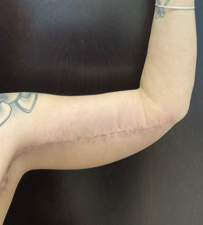 a tattoo on his head